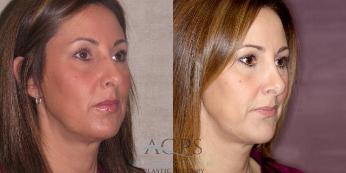 Before & After Chin Augmentation Case 1208 Oblique Right View: View in Houston, TX