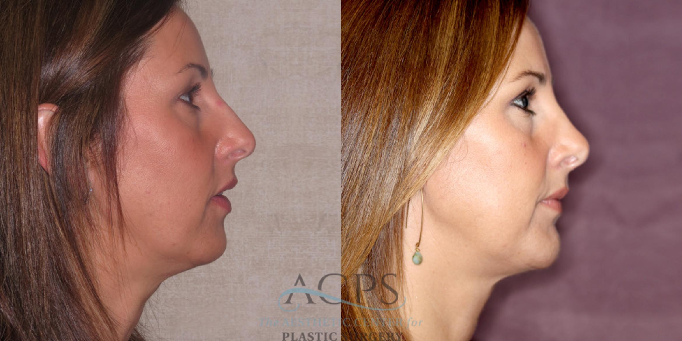 Before & After Chin Augmentation Case 1208 Side Right View: View in Houston, TX