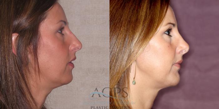 Before & After Chin Augmentation Case 1208 Side Right View: View in Houston, TX