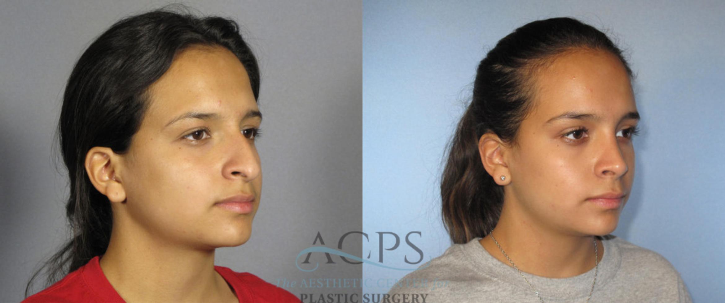 Before & After Rhinoplasty Case 1209 Oblique View: View in Houston, TX