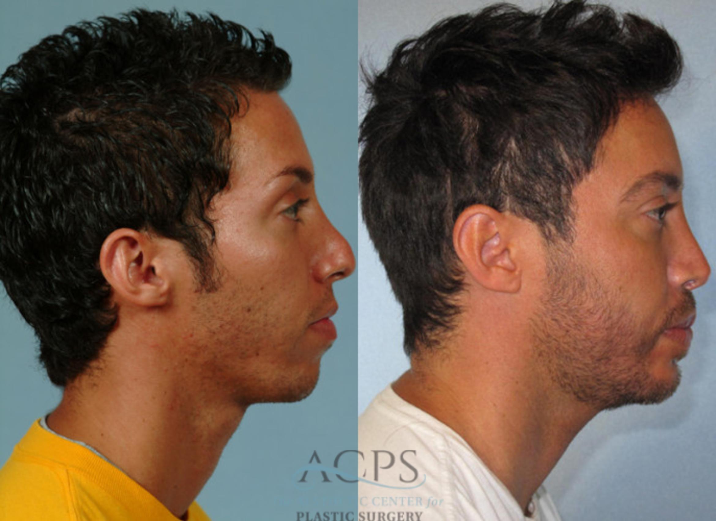 Before & After Rhinoplasty Case 1210 Side View: View in Houston, TX