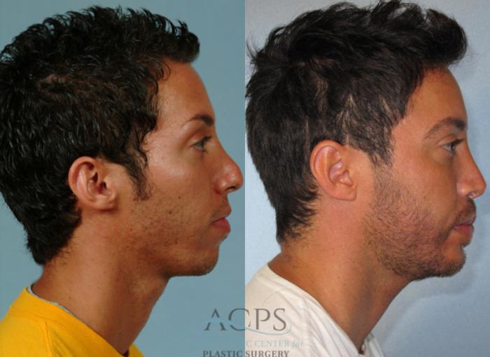 Before & After Rhinoplasty Case 1210 Side View: View in Houston, TX
