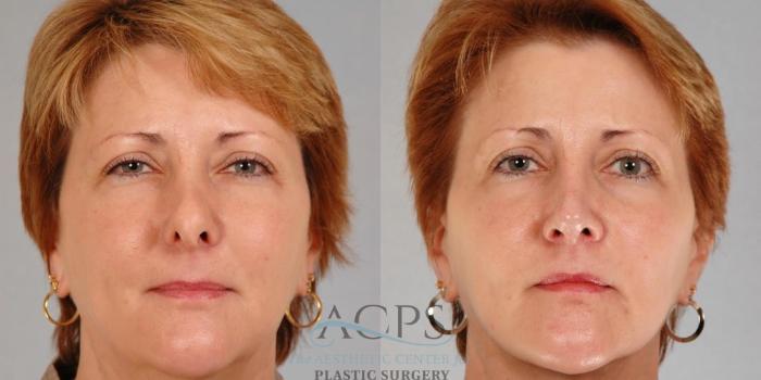 Before & After Rhinoplasty Case 1212 Front View: View in Houston, TX