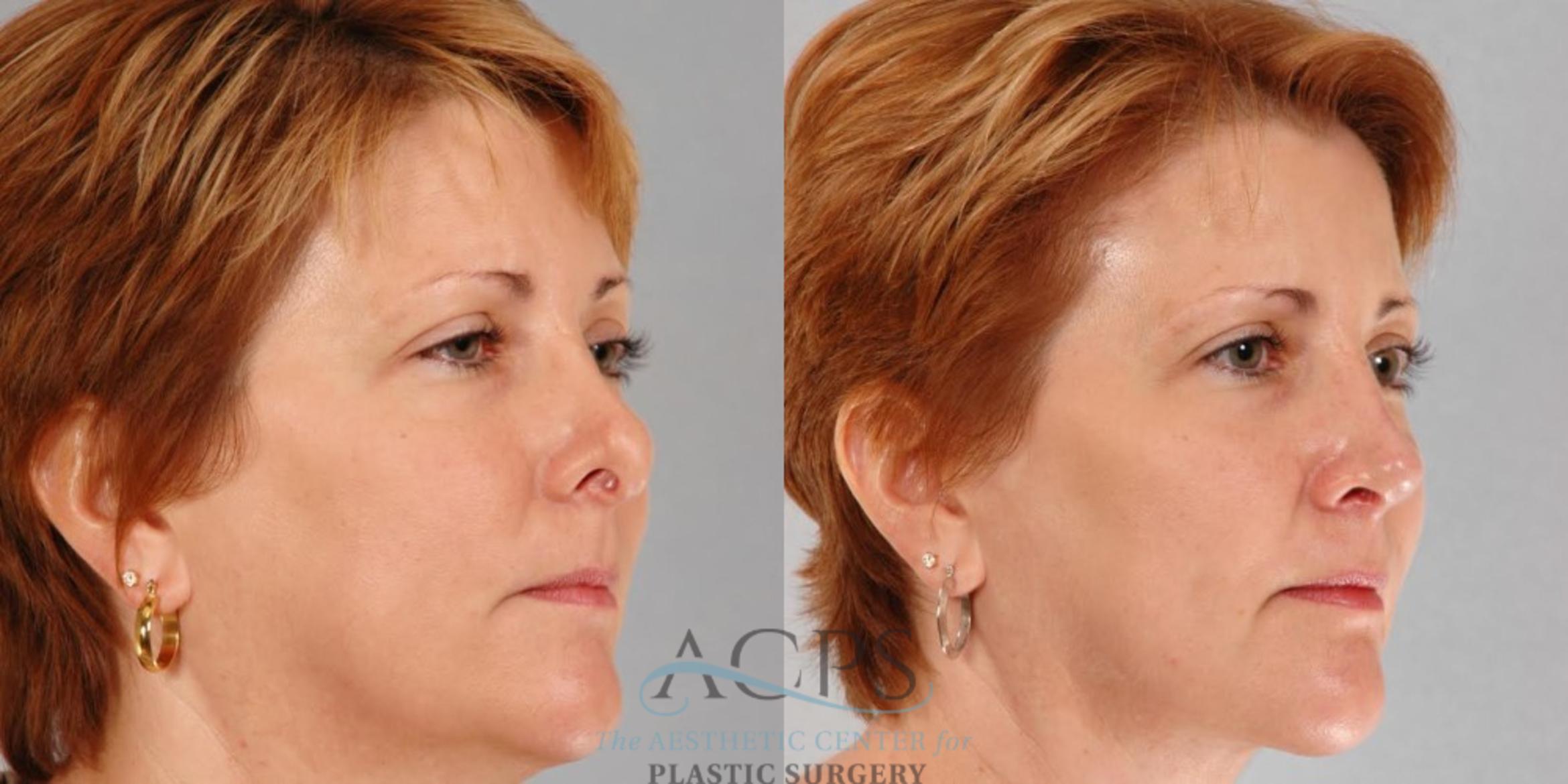Before & After Rhinoplasty Case 1212 Oblique View: View in Houston, TX
