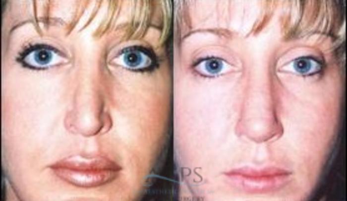Before & After Rhinoplasty Case 1213 Front View: View in Houston, TX