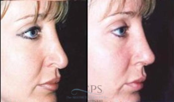 Before & After Rhinoplasty Case 1213 Oblique View: View in Houston, TX