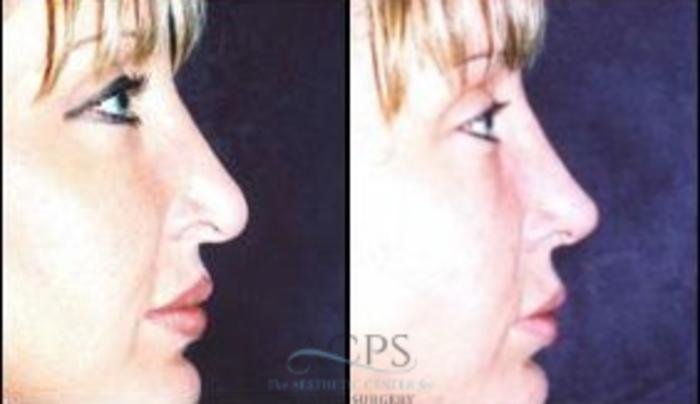 Before & After Rhinoplasty Case 1213 Side View: View in Houston, TX