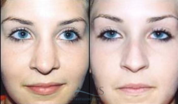 Before & After Rhinoplasty Case 1214 Front View: View in Houston, TX