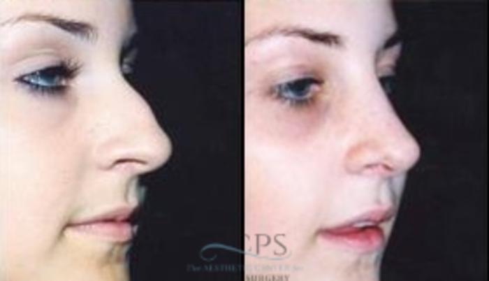 Before & After Rhinoplasty Case 1214 Oblique View: View in Houston, TX