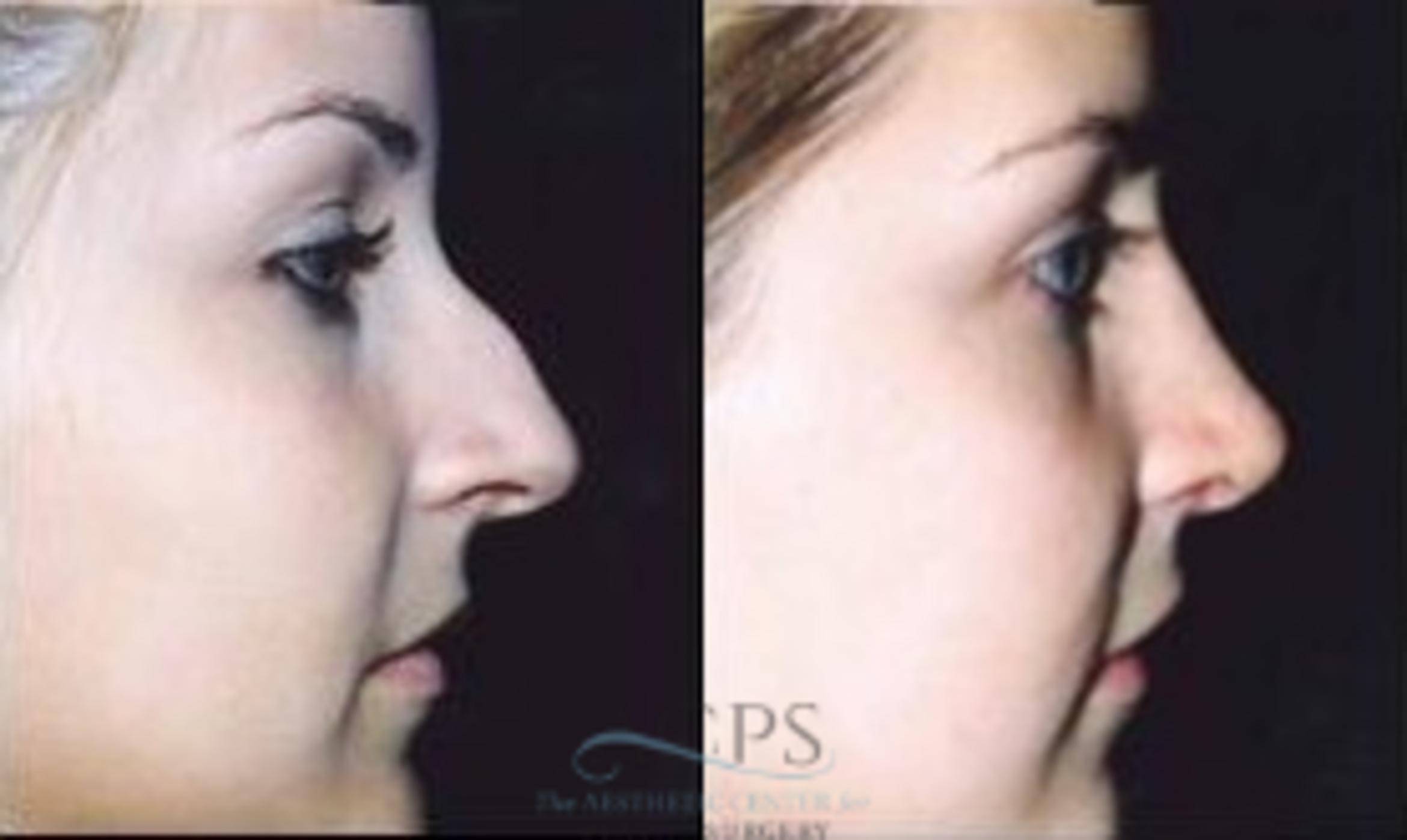 Before & After Rhinoplasty Case 1214 Side View: View in Houston, TX
