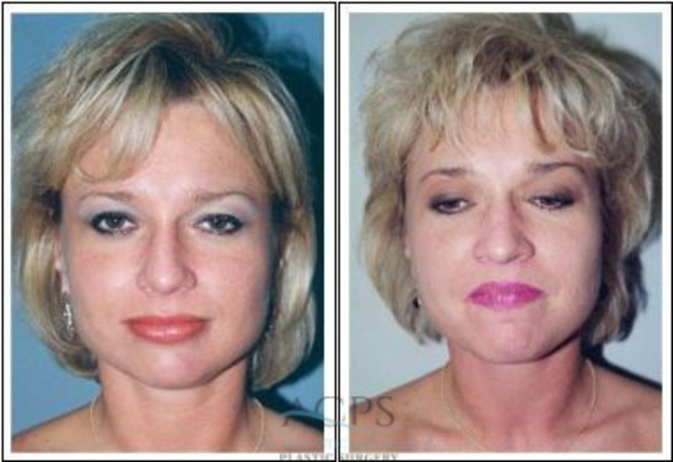 Before & After Rhinoplasty Case 1215 Front View: View in Houston, TX