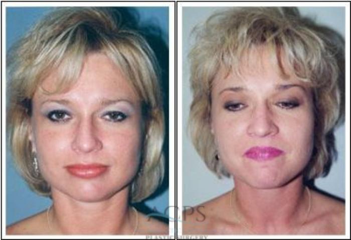 Before & After Rhinoplasty Case 1215 Front View: View in Houston, TX