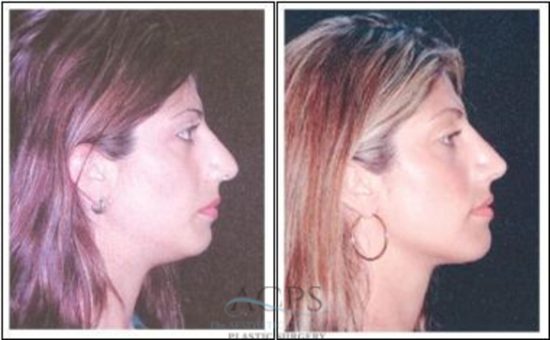 Before & After Rhinoplasty Case 1216 Side View: View in Houston, TX