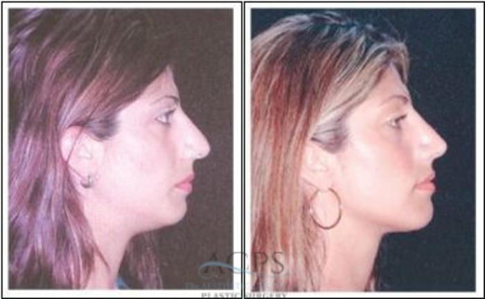 Before & After Rhinoplasty Case 1216 Side View: View in Houston, TX