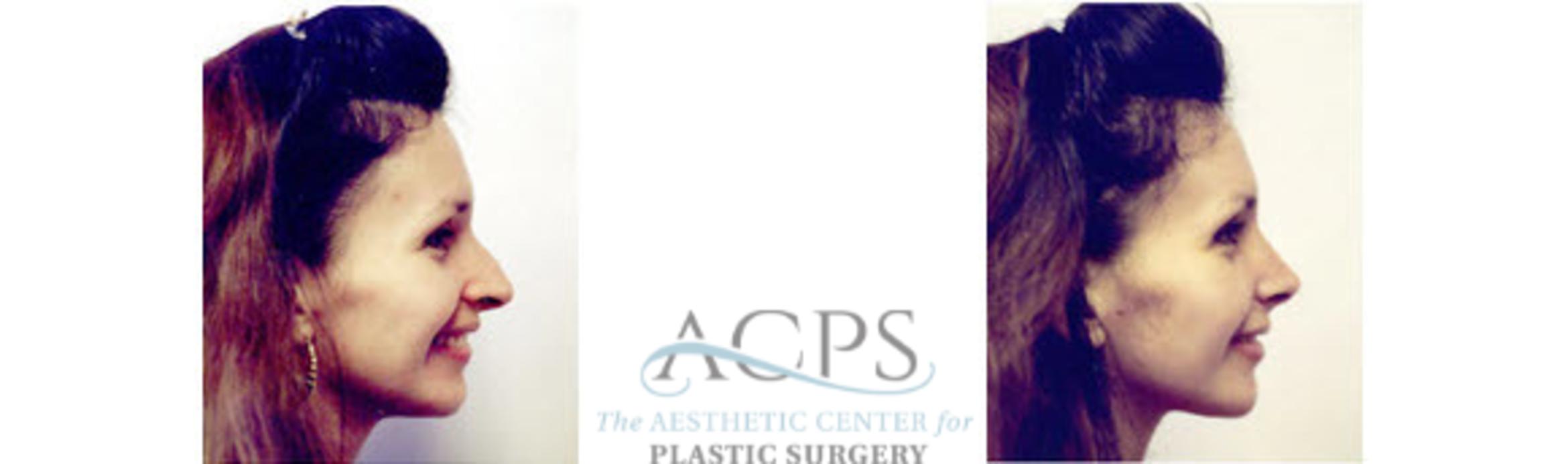 Before & After Rhinoplasty Case 1217 Side View: View in Houston, TX