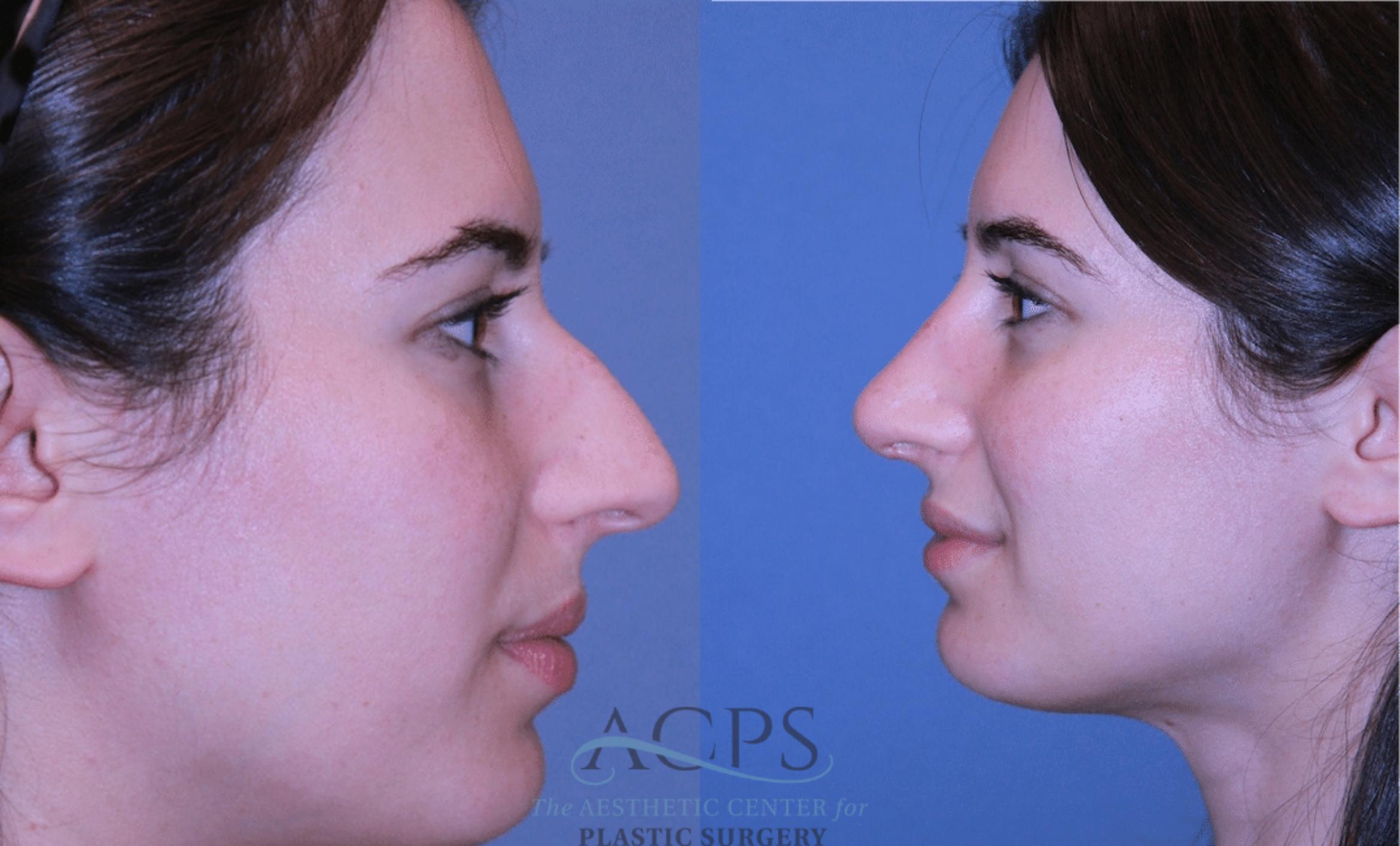 Before & After Rhinoplasty Case 1464 Left Side View in Houston, TX