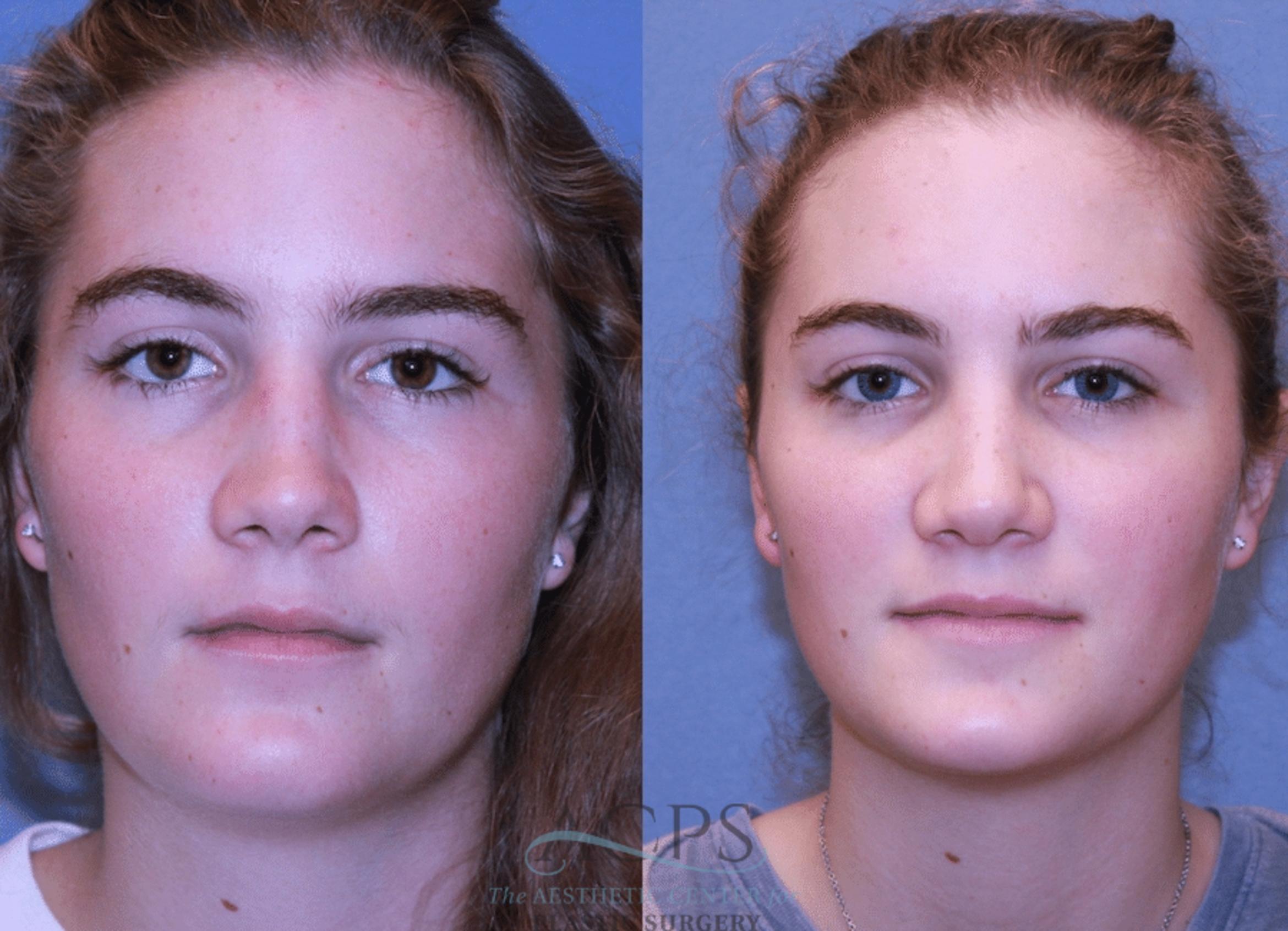 Before & After Rhinoplasty Case 1465 Front View in Houston, TX