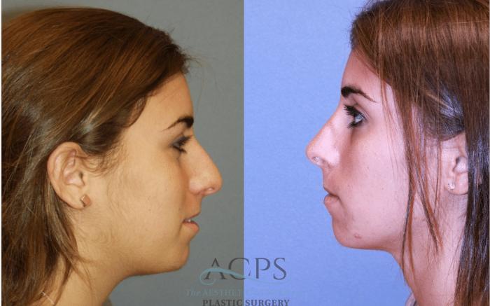 Before & After Rhinoplasty Case 1466 Left Side View in Houston, TX