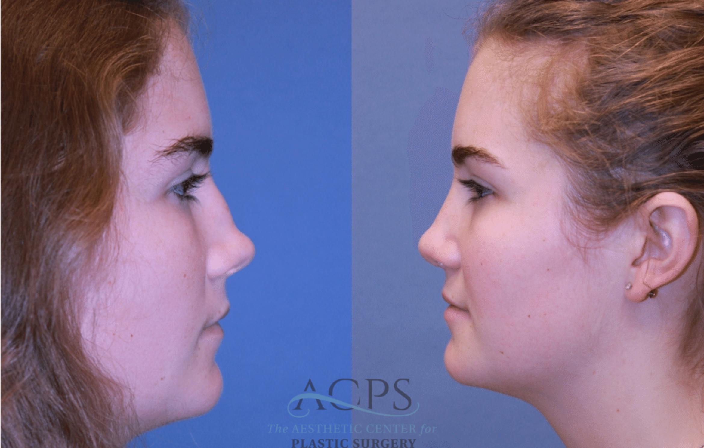 Before & After Rhinoplasty Case 1467 Left Side View in Houston, TX