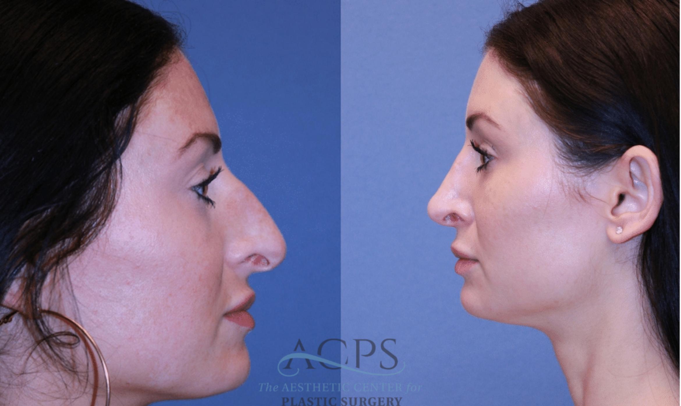 Before & After Rhinoplasty Case 1468 Left Side View in Houston, TX