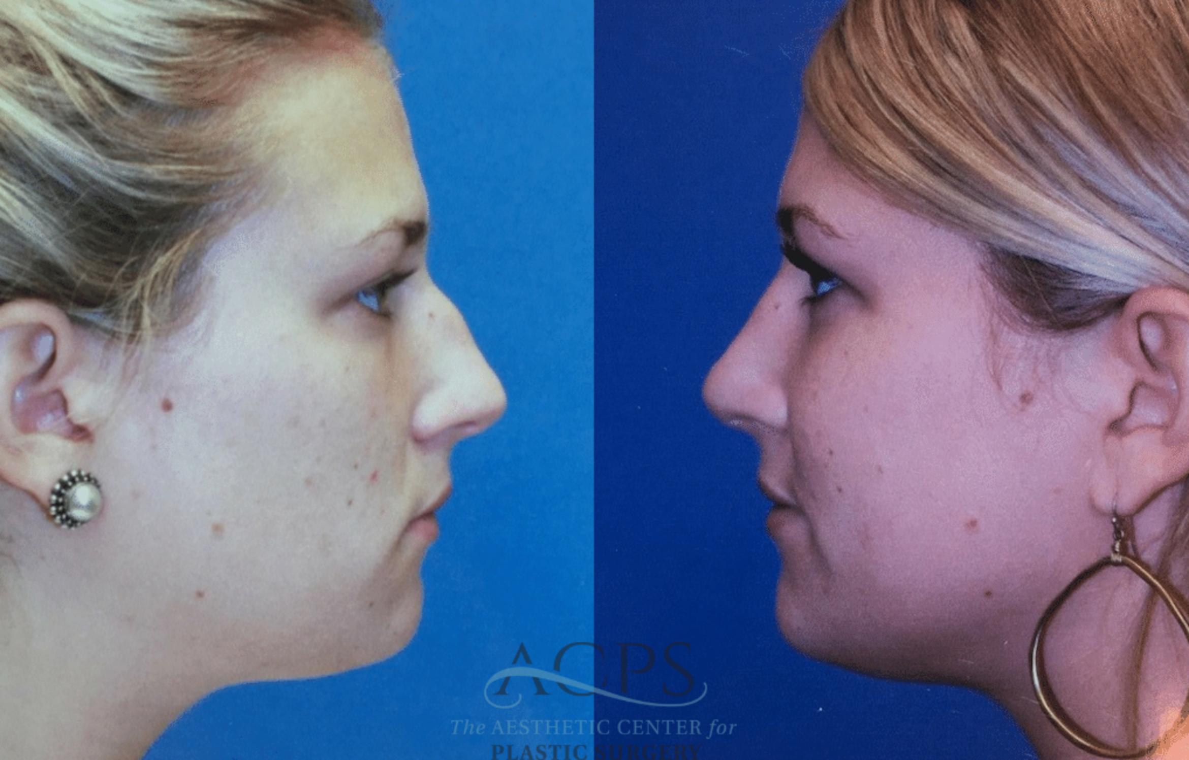 Before & After Rhinoplasty Case 1469 Left Side View in Houston, TX