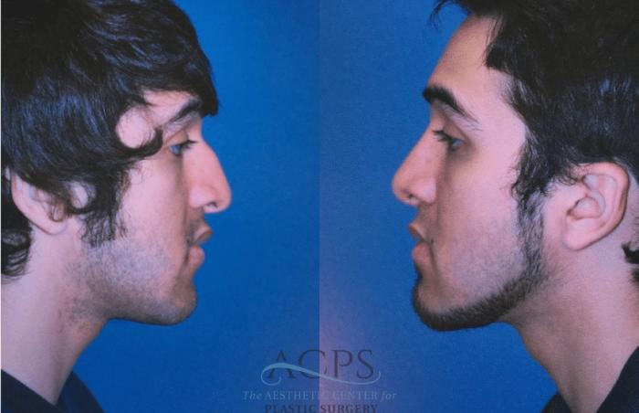 Before & After Rhinoplasty Case 1470 Left Side View in Houston, TX