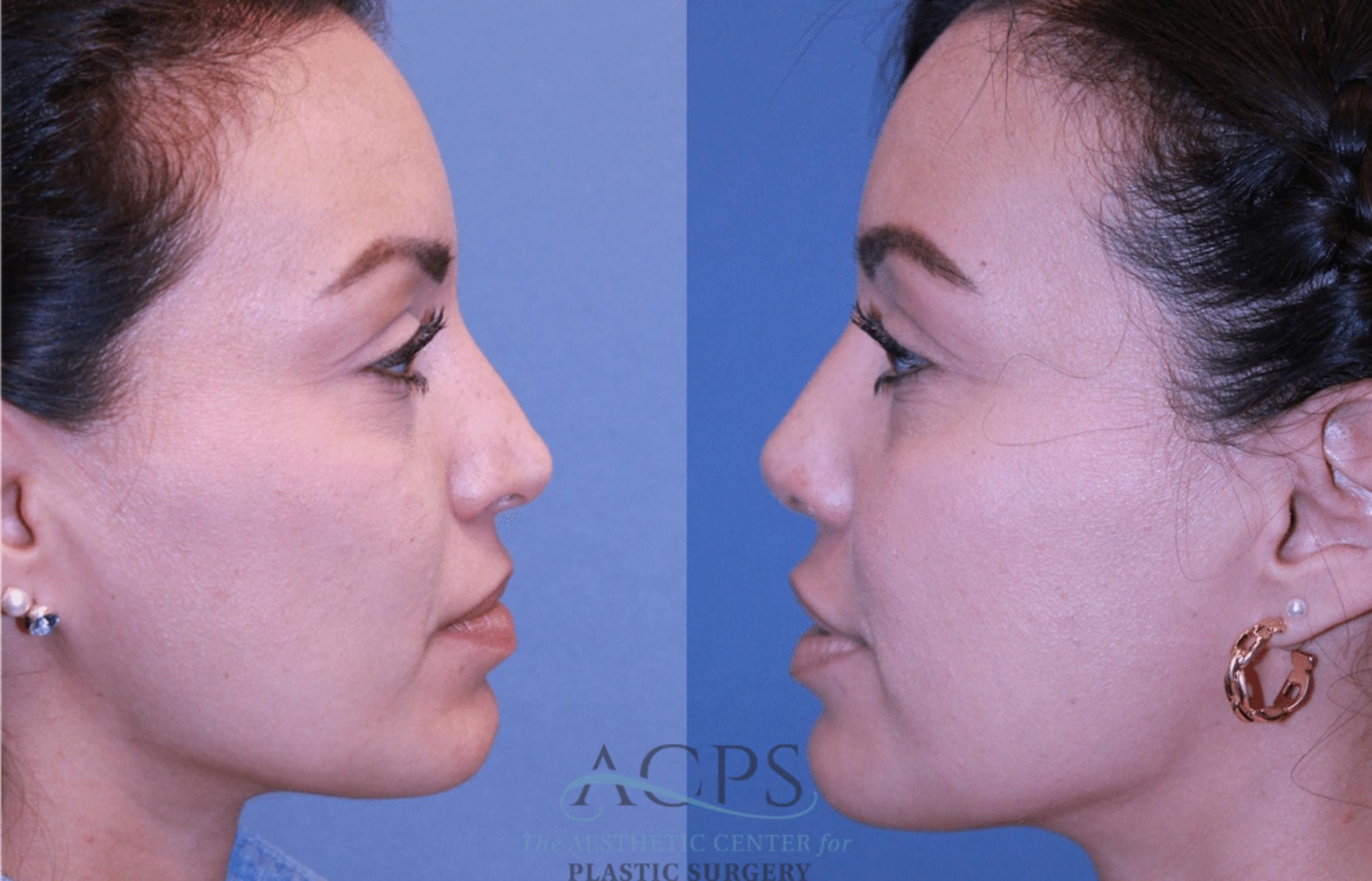 Before & After Rhinoplasty Case 1471 Left Side View in Houston, TX