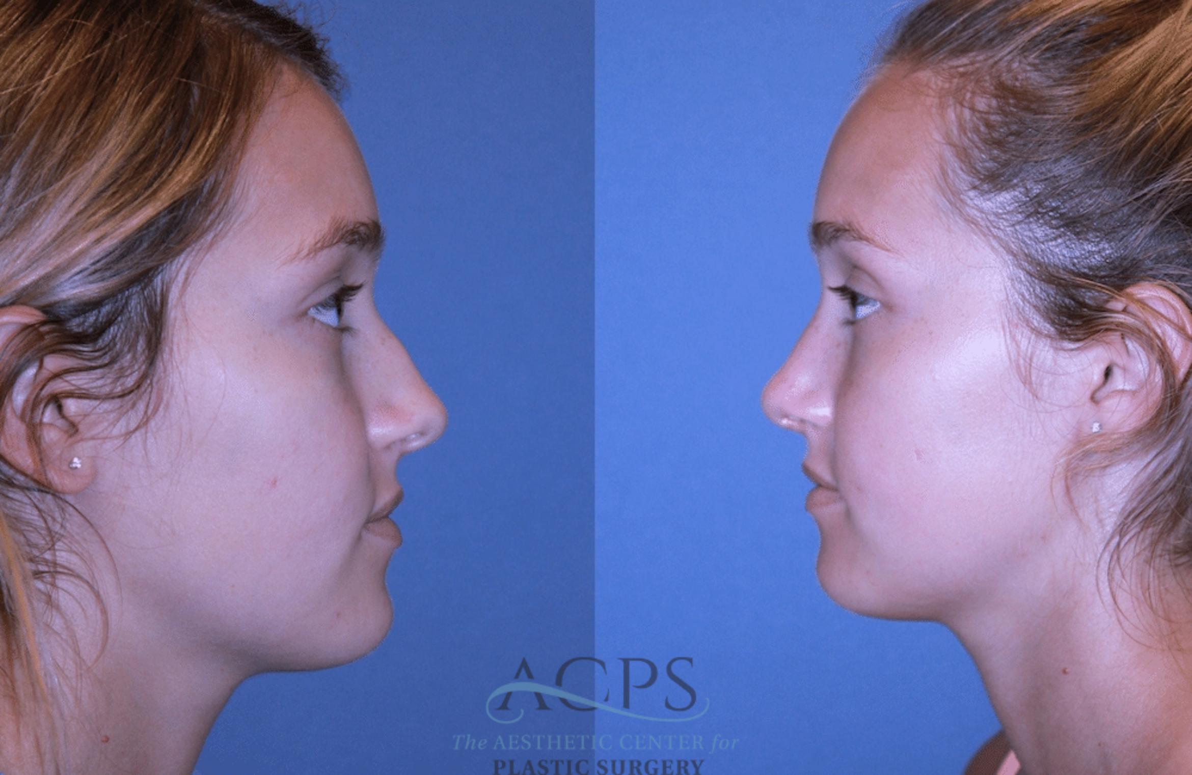 Before & After Rhinoplasty Case 1472 Left Side View in Houston, TX