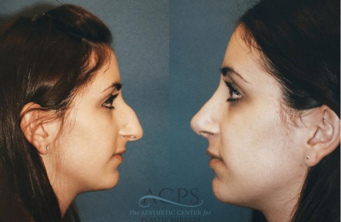 Before & After Rhinoplasty Case 1473 Left Side View in Houston, TX