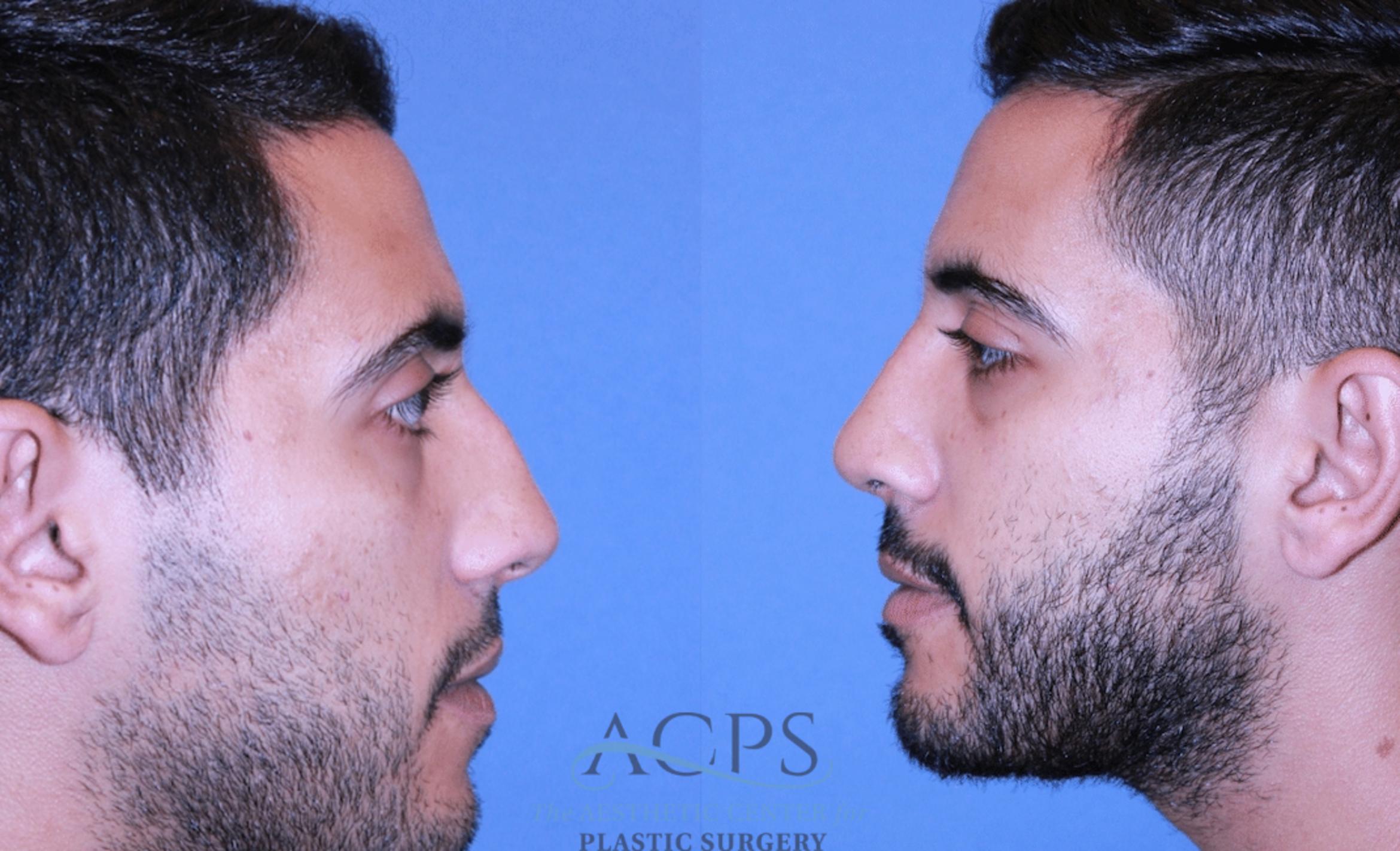 Before & After Rhinoplasty Case 1474 Left Side View in Houston, TX
