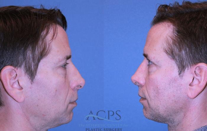 Before & After Rhinoplasty Case 1475 Left Side View in Houston, TX
