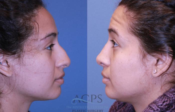 Before & After Rhinoplasty Case 1476 Left Side View in Houston, TX