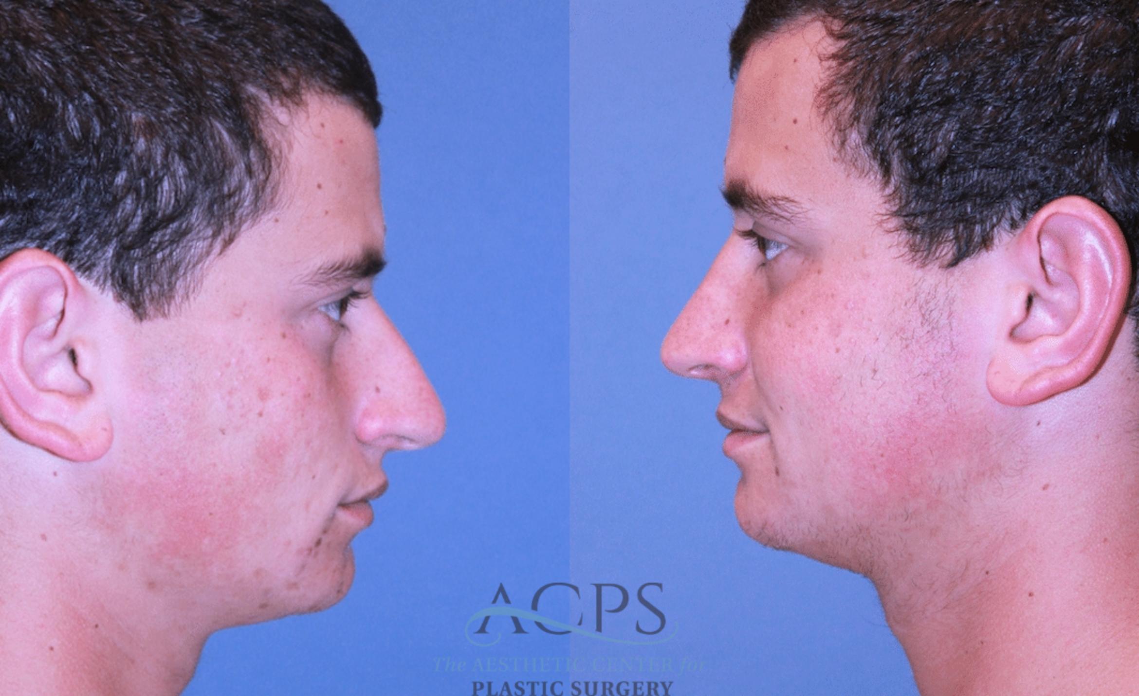 Before & After Rhinoplasty Case 1477 Left Side View in Houston, TX