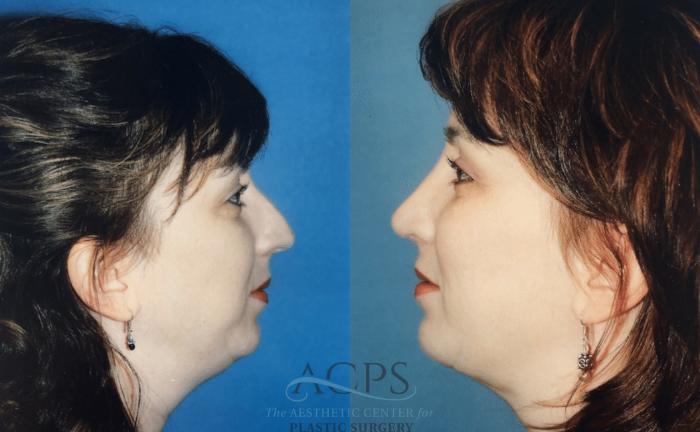 Before & After Rhinoplasty Case 1478 Left Side View in Houston, TX