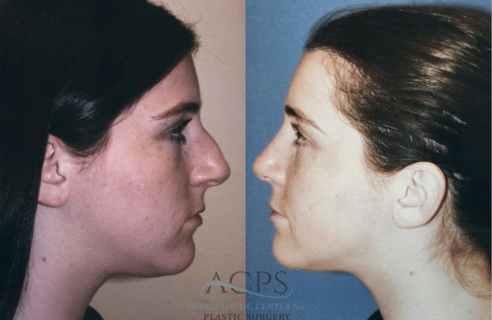 Before & After Rhinoplasty Case 1479 Left Side View in Houston, TX