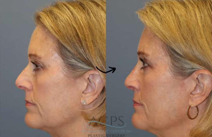 Before & After Rhinoplasty Case 1480 Left Side View in Houston, TX