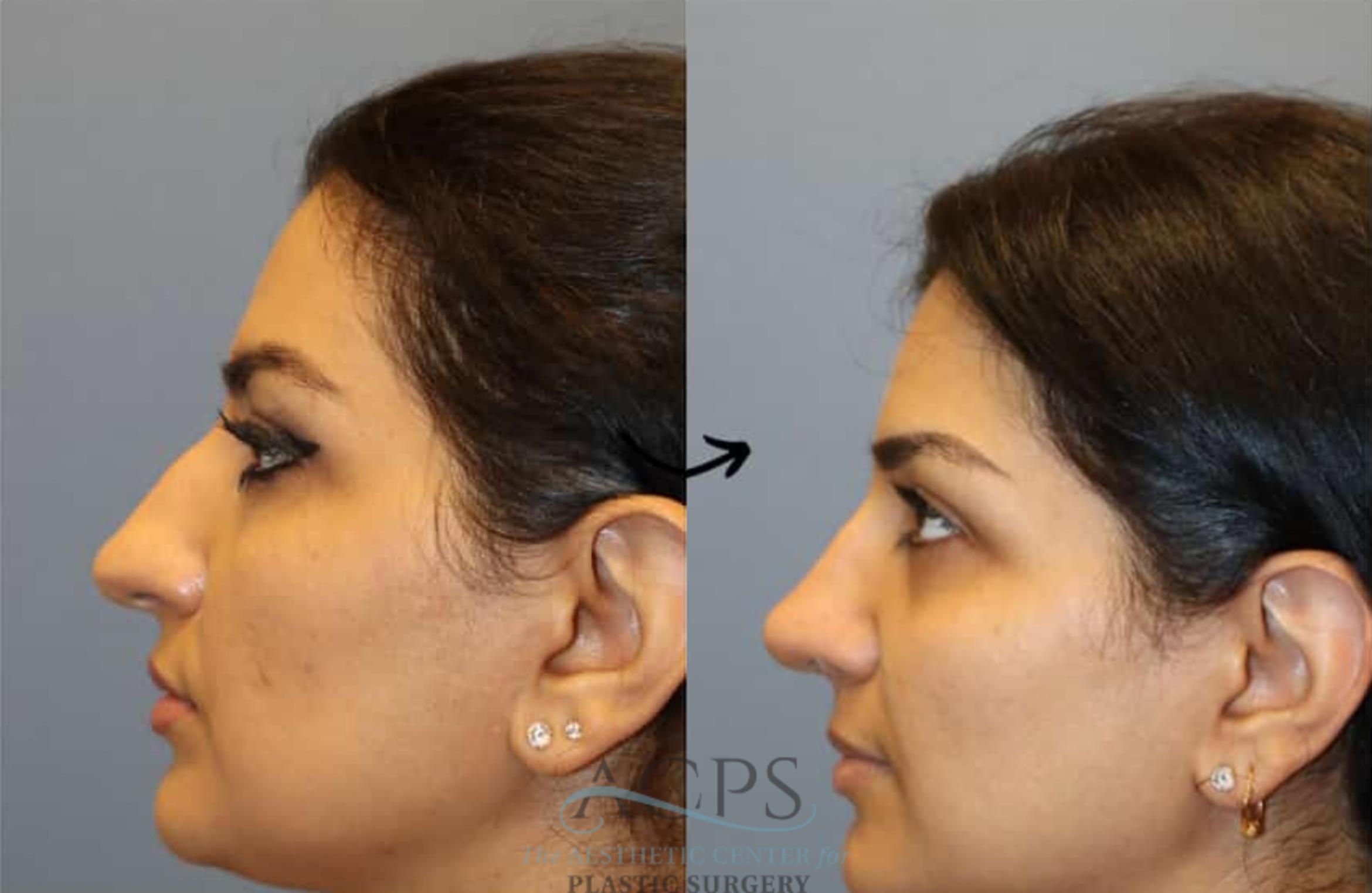 Before & After Rhinoplasty Case 1481 Left Side View in Houston, TX