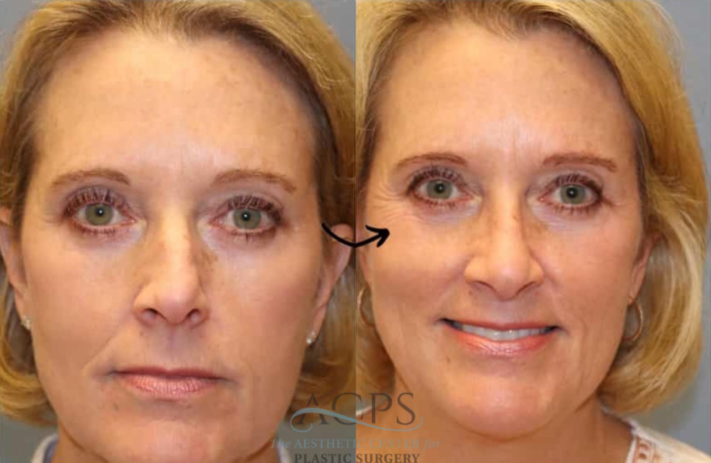 Before & After Rhinoplasty Case 1482 Front View in Houston, TX