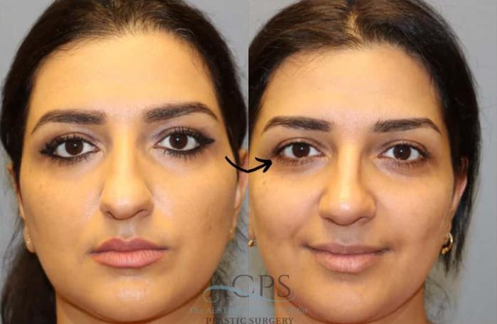 Before & After Rhinoplasty Case 1483 Front View in Houston, TX