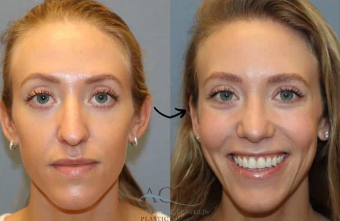 Before & After Rhinoplasty Case 1484 Front View in Houston, TX