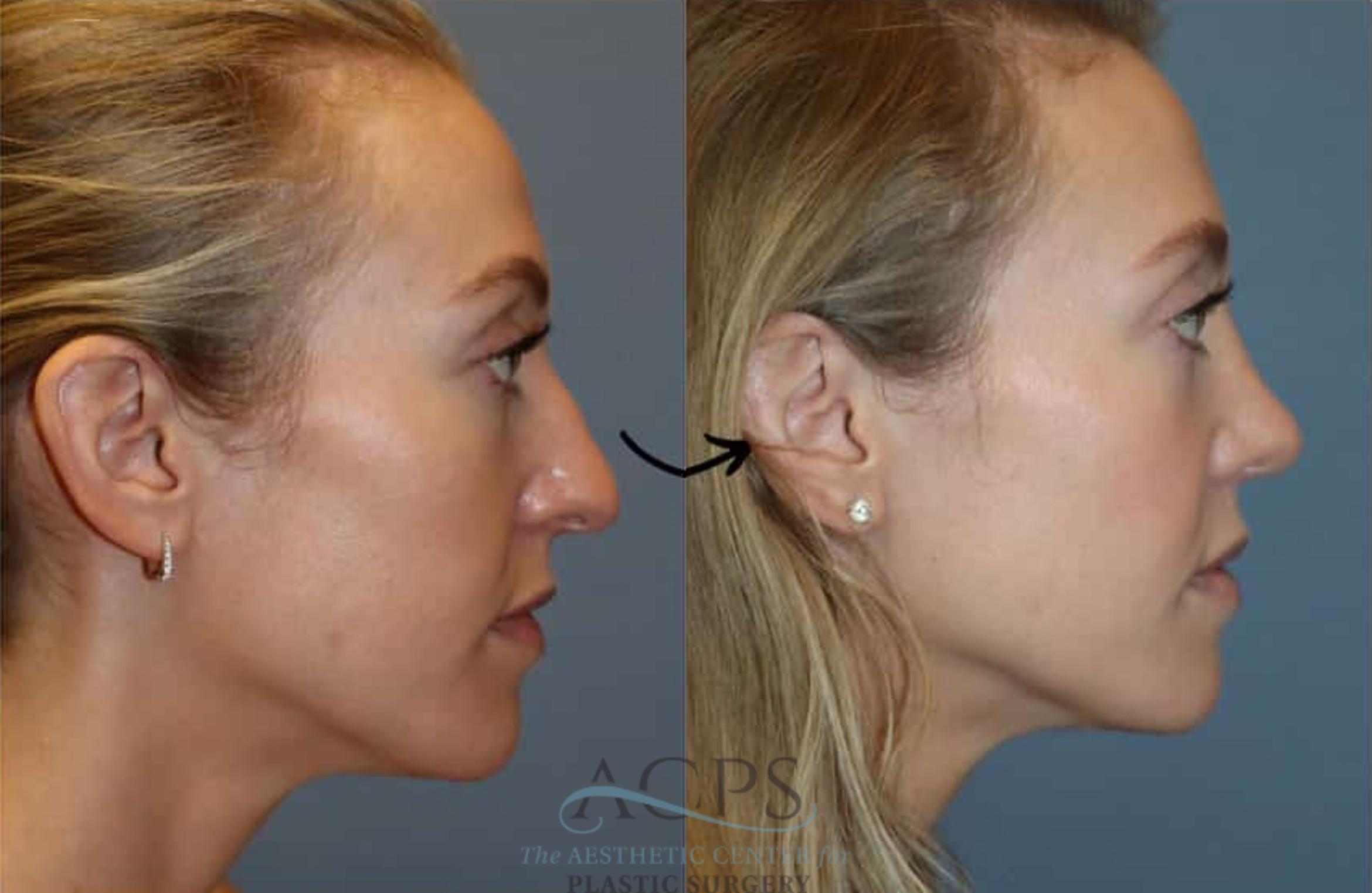 Before & After Rhinoplasty Case 1485 Right Side View in Houston, TX
