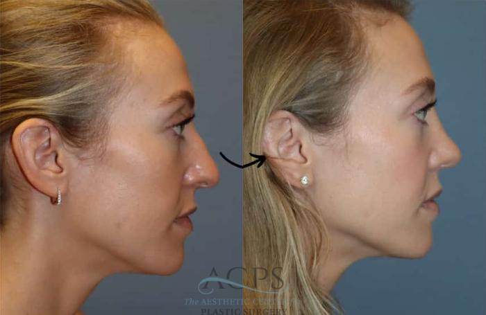 Before & After Rhinoplasty Case 1485 Right Side View in Houston, TX