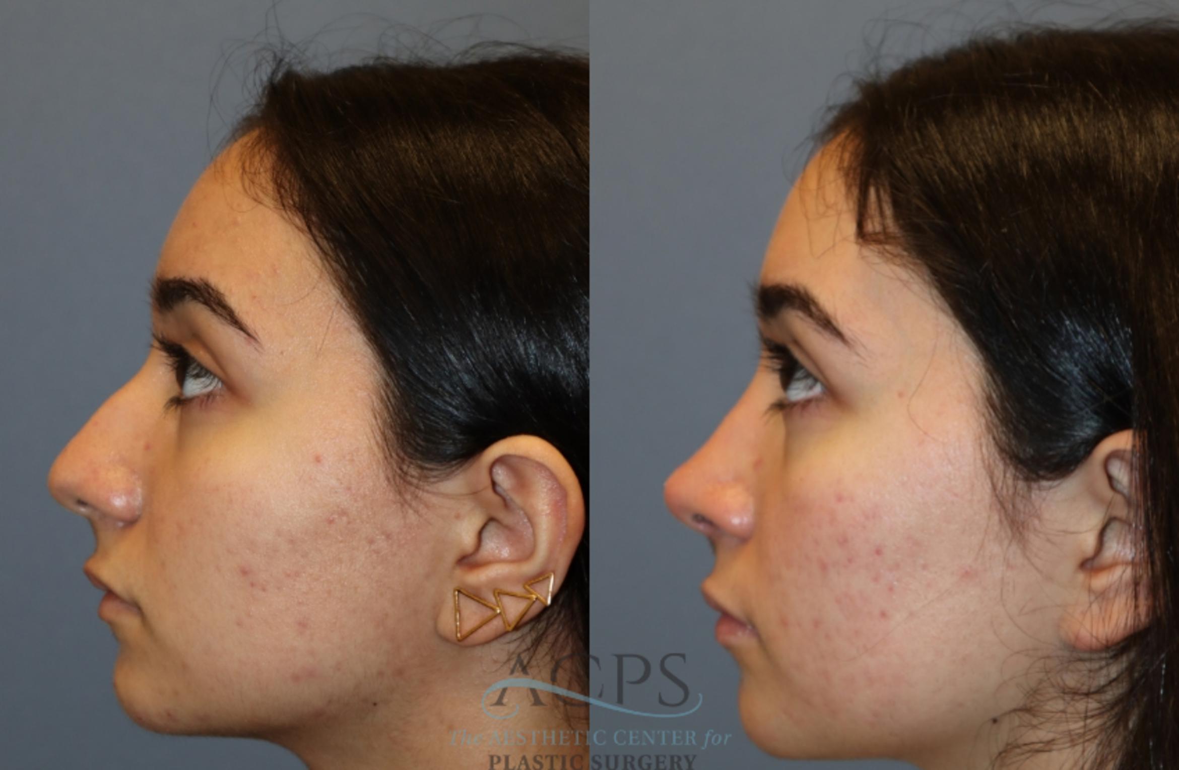 Before & After Rhinoplasty Case 1486 Left Side View in Houston, TX