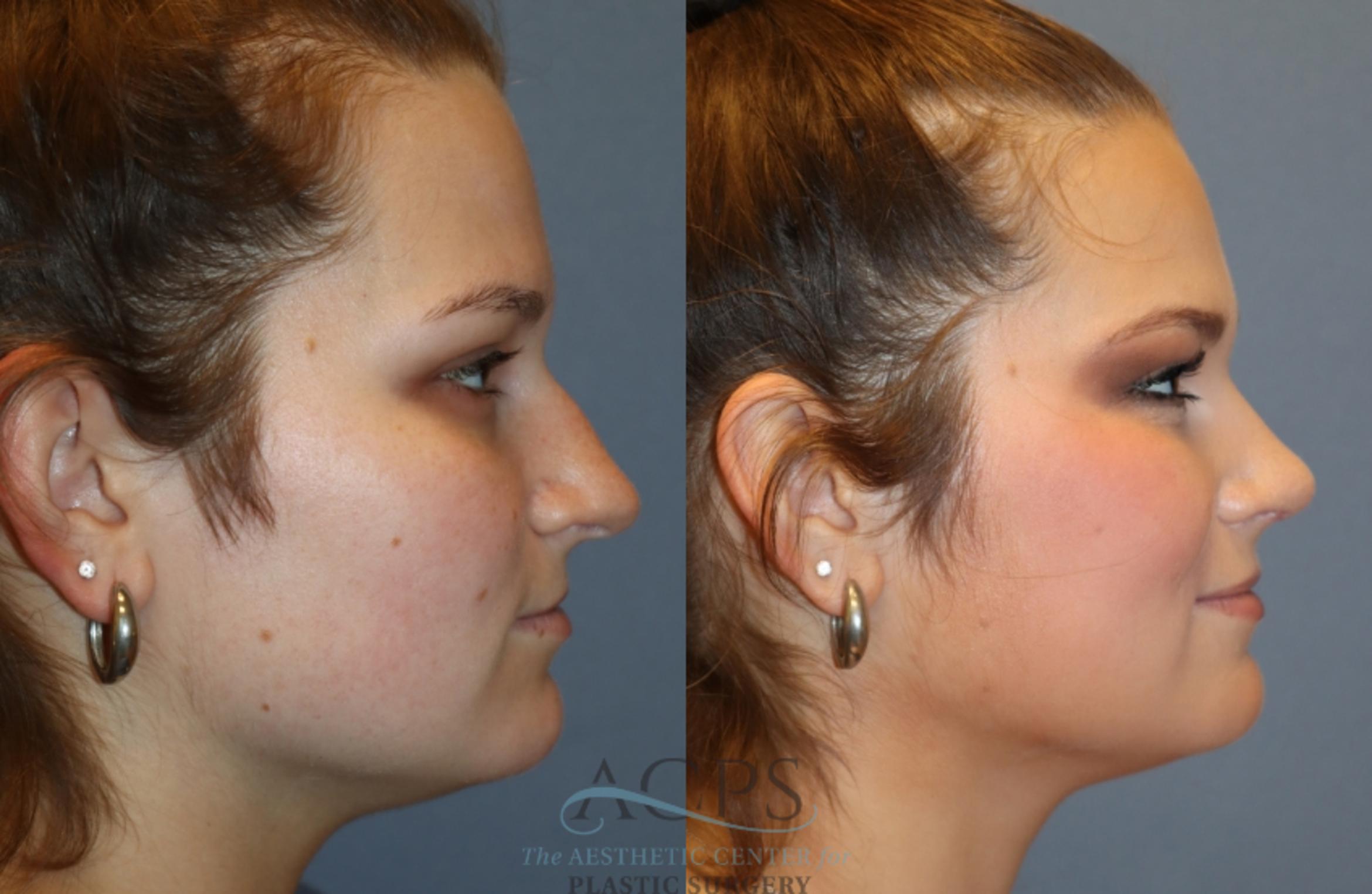 Before & After Rhinoplasty Case 1487 Right Side View in Houston, TX