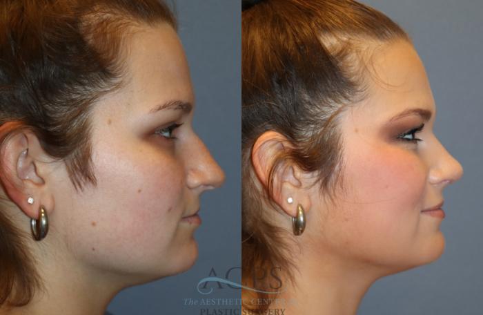 Before & After Rhinoplasty Case 1487 Right Side View in Houston, TX