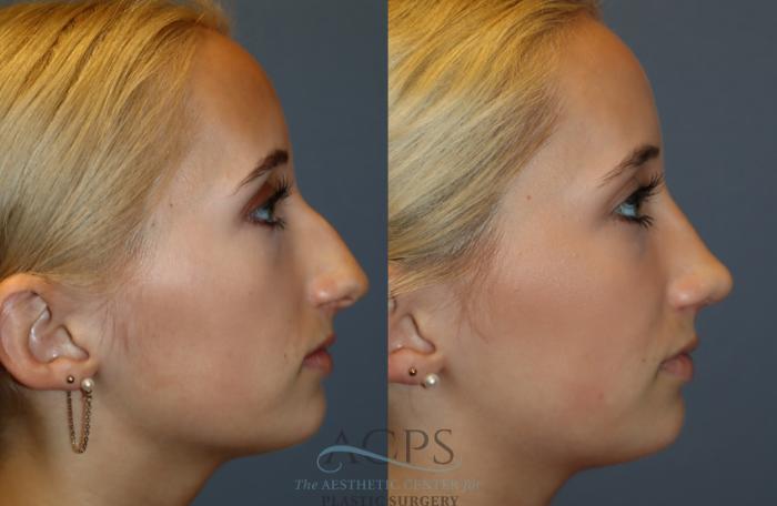 Before & After Rhinoplasty Case 1488 Right Side View in Houston, TX