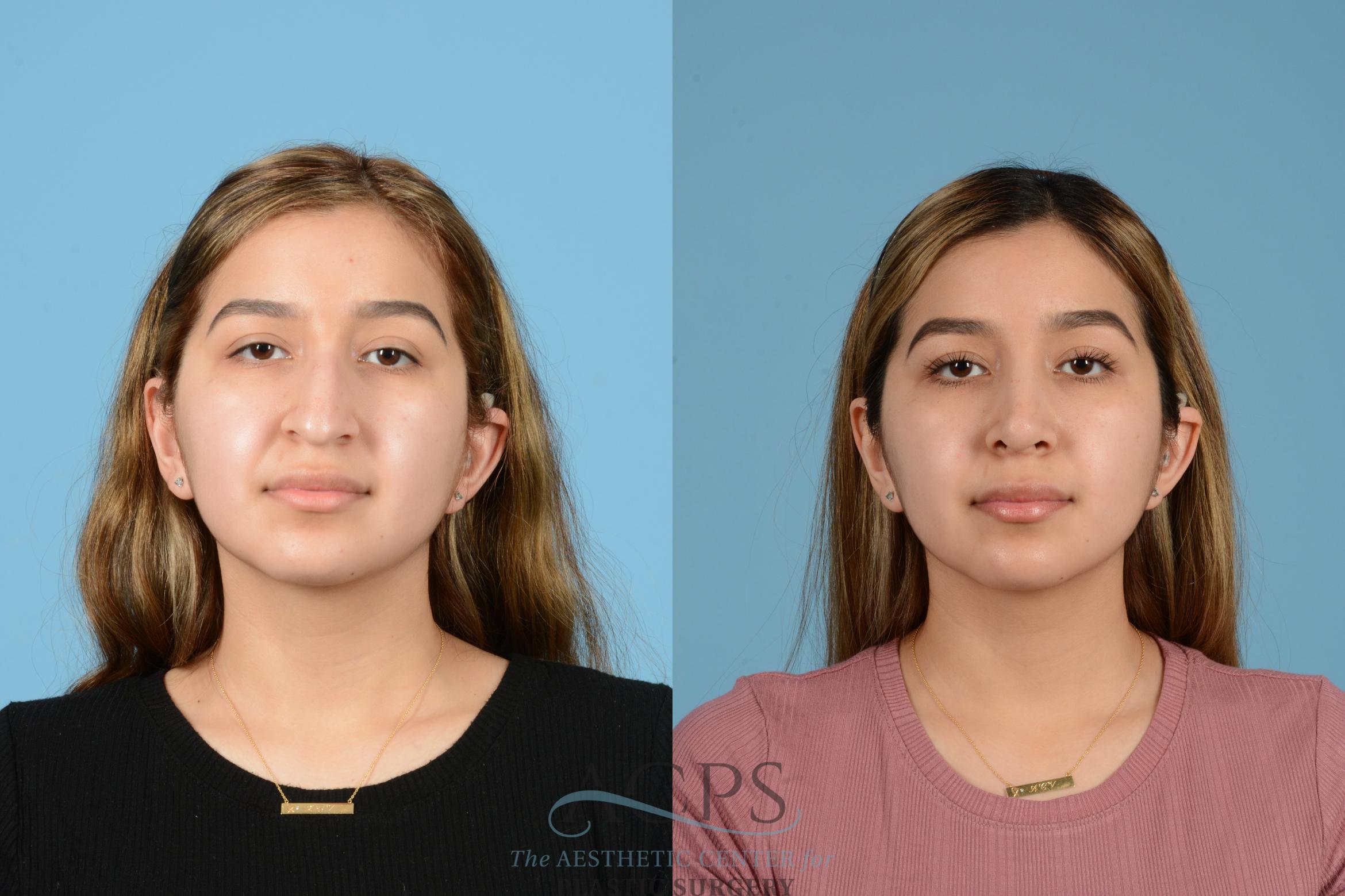 Before & After Rhinoplasty Case 1516 Front View in Houston, TX
