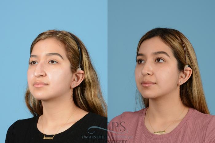 Before & After Rhinoplasty Case 1516 Left Oblique View in Houston, TX