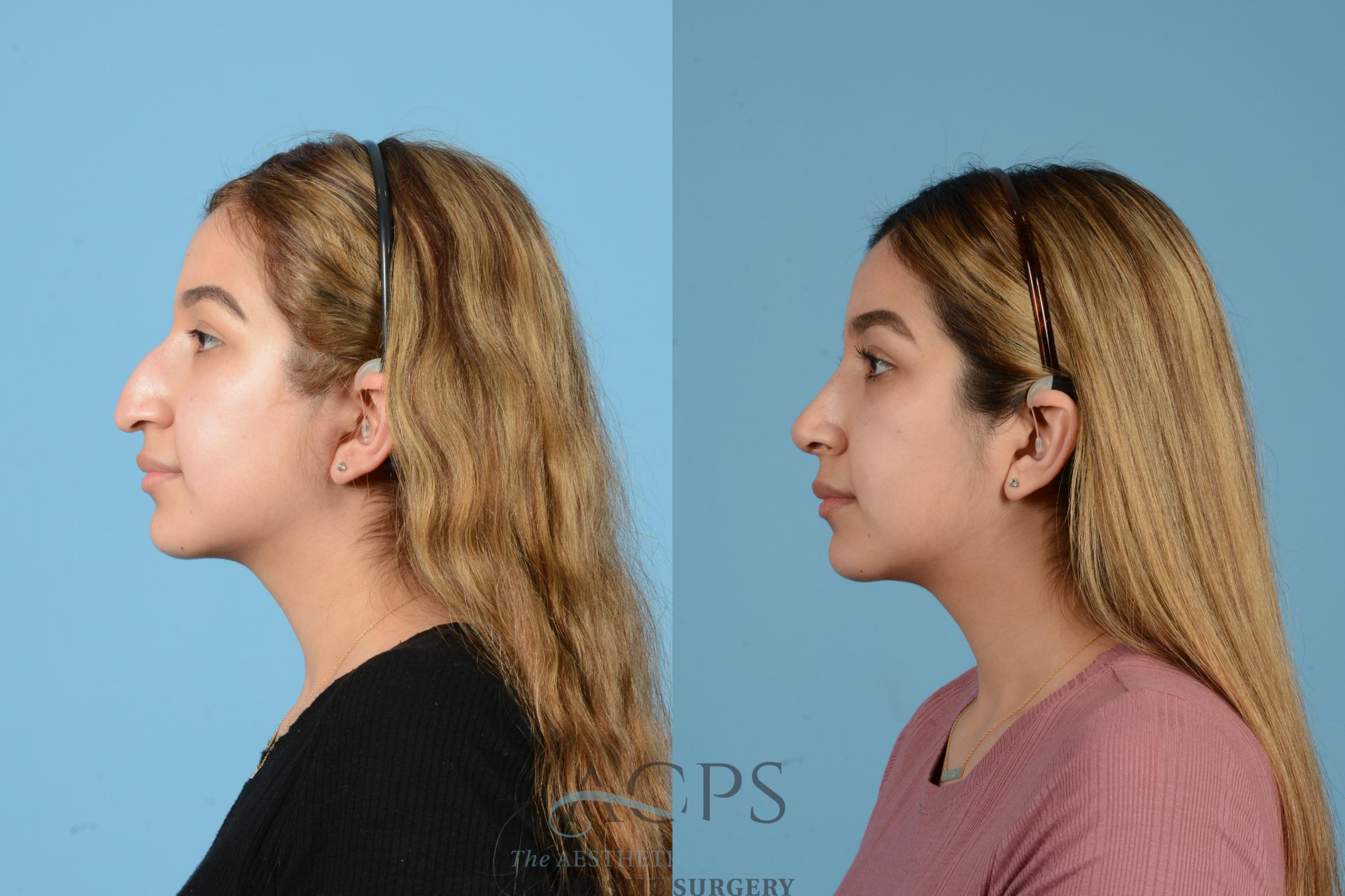 Before & After Rhinoplasty Case 1516 Left Side View in Houston, TX