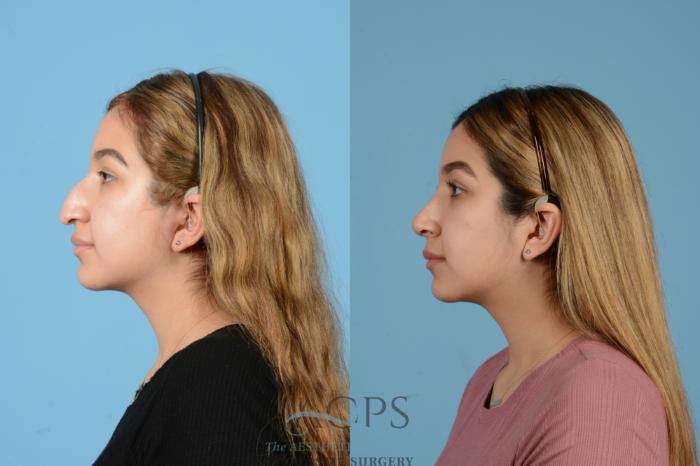 Before & After Septoplasty with Rhinoplasty Case 1516 Left Side View in Houston, TX